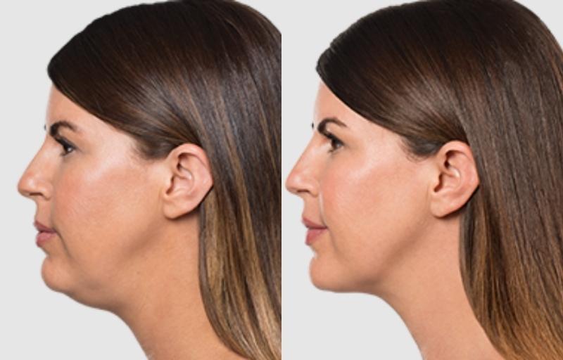 kybella before after kybella before after