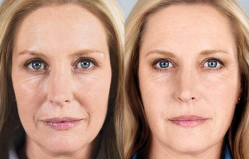 sculptra before after sculptra before after