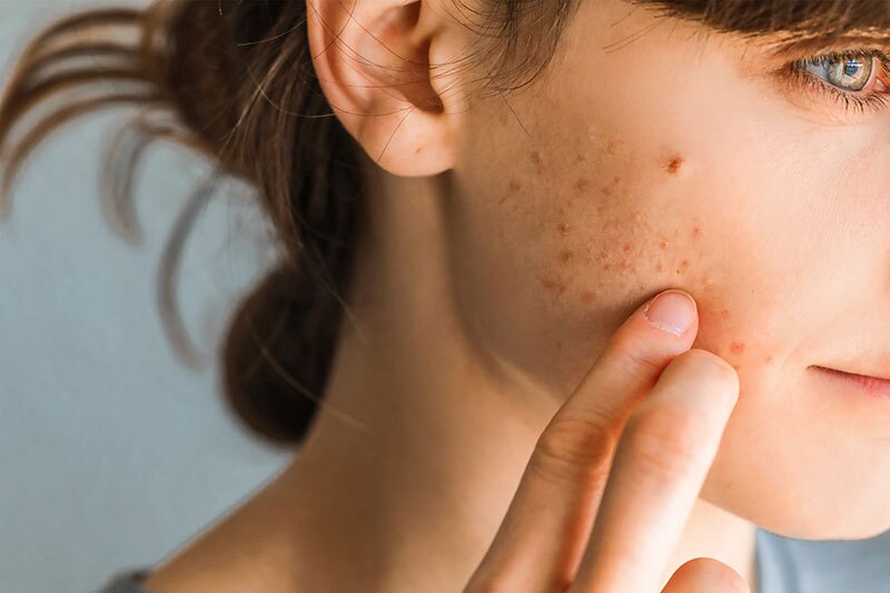 June is Acne Awareness Month: Discover the Power of Aviclear at SkinLab NYC