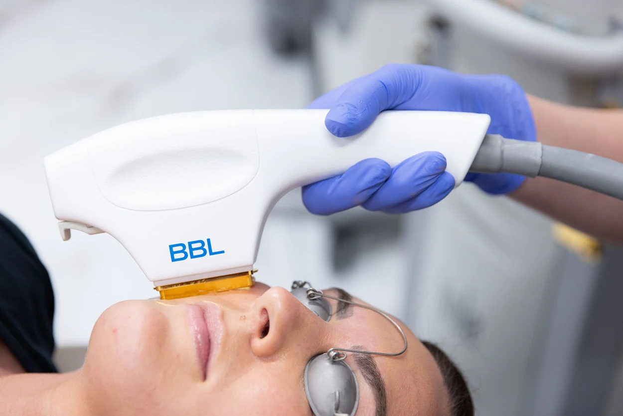 Forever Young BBL SkinLab NYC Forever Young BBL SkinLab NYC