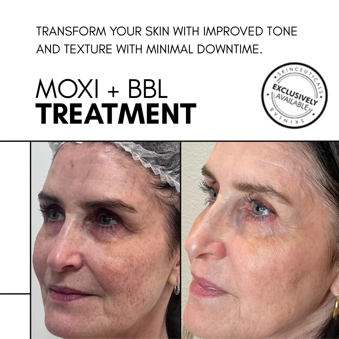 Moxi and BBL Before After SkinLab NYC Moxi and BBL Before After SkinLab NYC