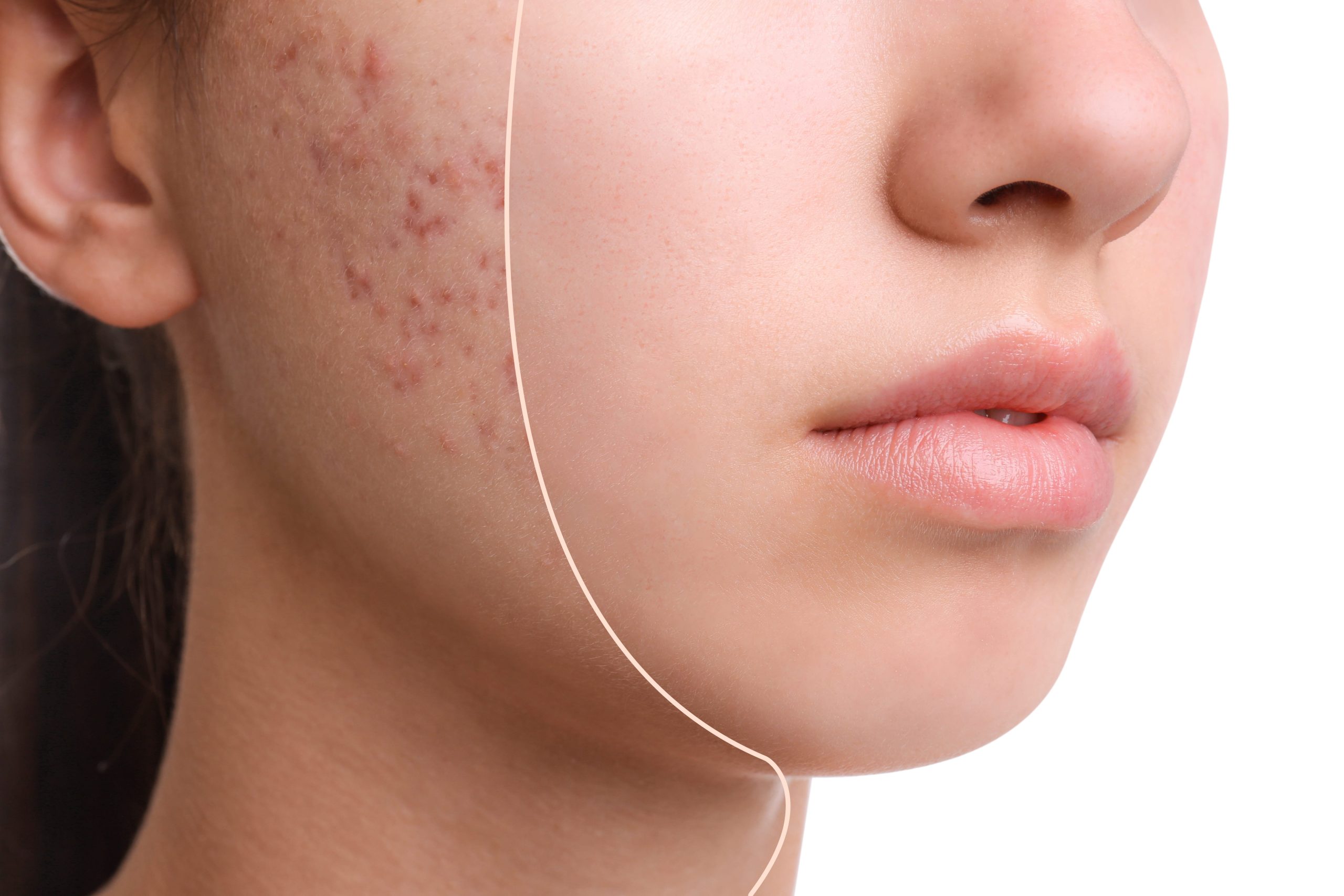 acne treatments before after side profile acne treatments before after side profile