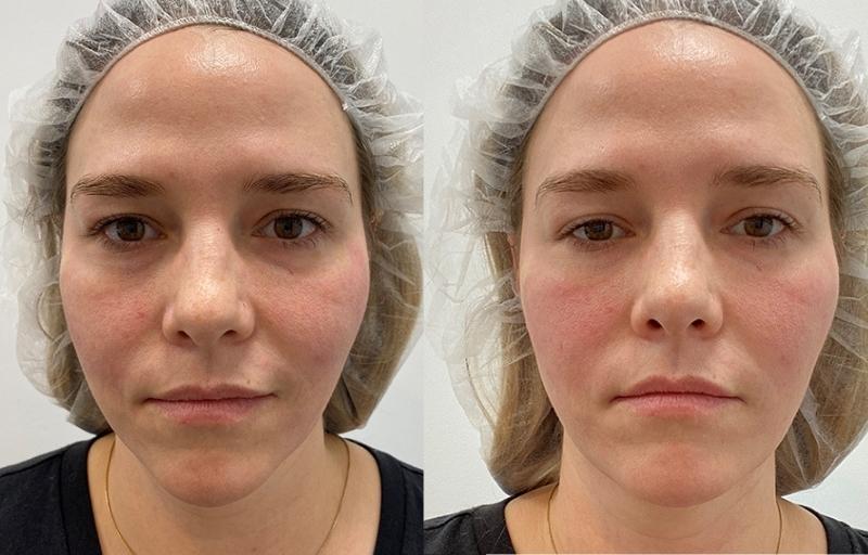 pdo thread lift before after
